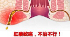 > 哪家医院治疗肛瘘好