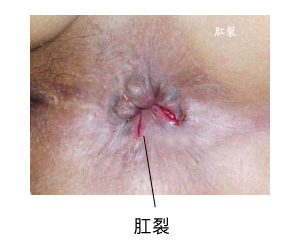 济南哪家医院治疗肛裂出血好