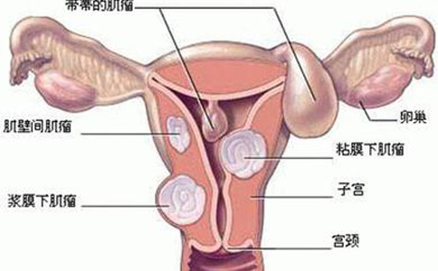 性生活也会引起盆腔炎吗