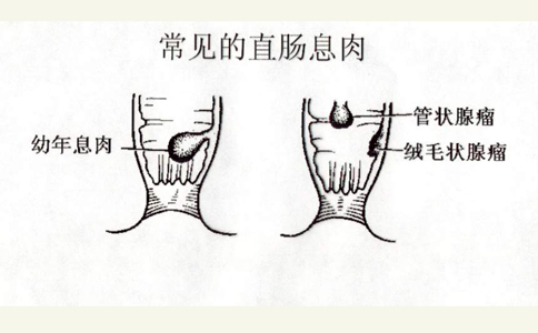 直肠息肉手术后要注意些什么?