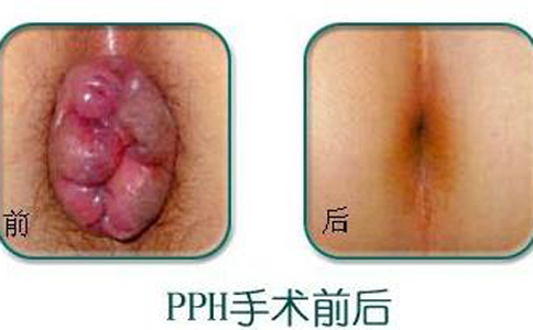 外痔一定要手术吗