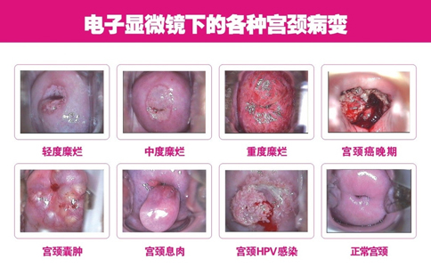 中度宫颈糜烂用做手术吗