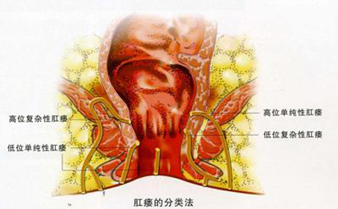 做完肛瘘手术后要注意哪些
