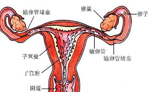 女性输卵管不通的症状有哪些