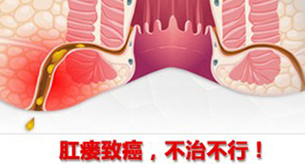 肛瘘不治疗会怎么样