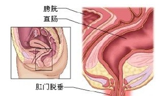 脱肛图片