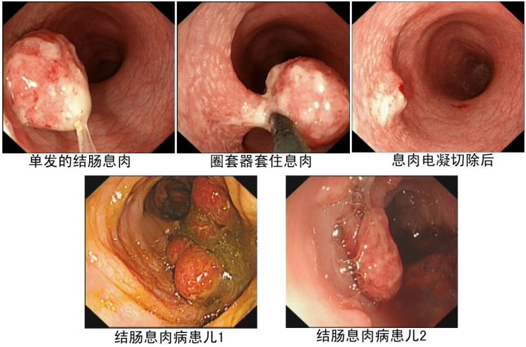 直肠息肉图片
