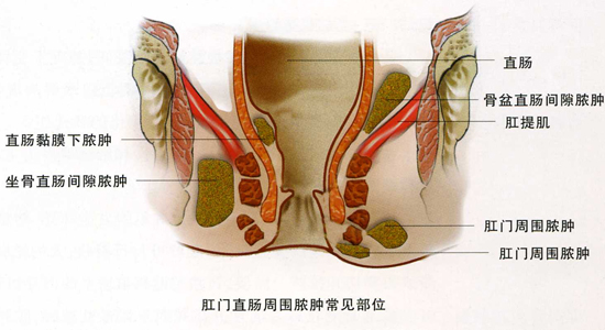 得了肛周脓肿如何治疗好