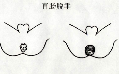 直肠脱垂症状图片