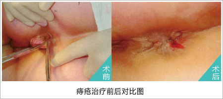 痔疮不治疗会怎么样