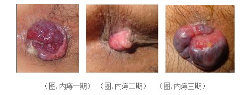 内痔的症状和治疗方法