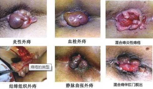 外痔如何治疗