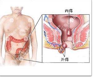 外痔疮对人体的危害