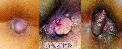 济南是如何做痔疮手术的