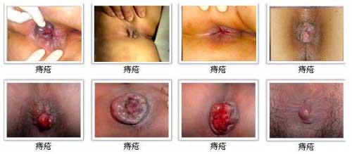 痔疮发作怎么办