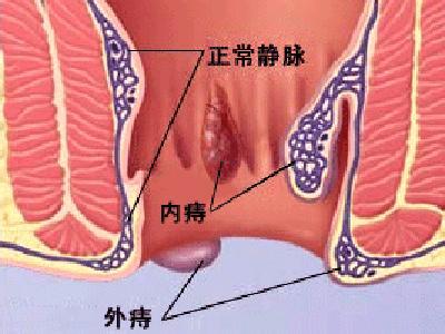 痔疮的治疗方法哪种好