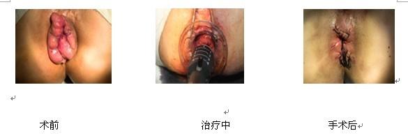 混合痔发病的原因是什么