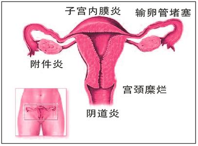 女性得了附件炎有什么症状