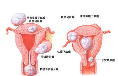 盆腔炎要怎么治疗好