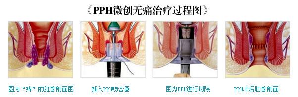 得了痔疮去哪治疗好