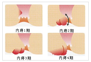 内痔疮必须手术进行治疗吗