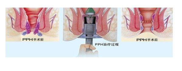 怎么治疗痔疮不疼