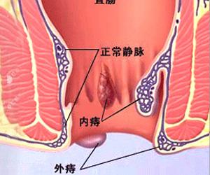痔疮图片的样子