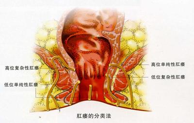 肛瘘手术之后多久能恢复
