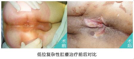 低位肛瘘的症状