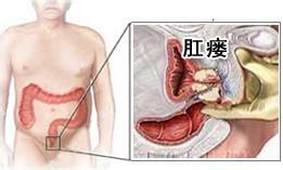 肛瘘是怎么形成的