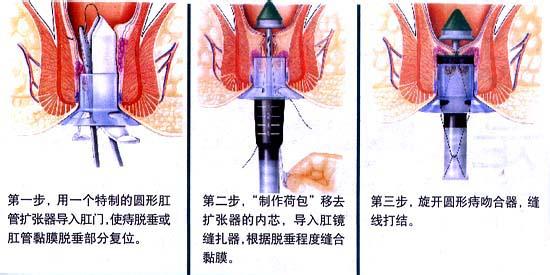 PPH治疗痔疮