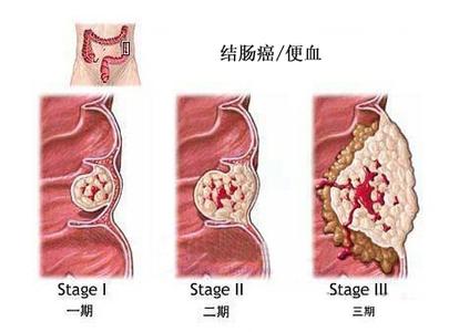 痔疮不治疗自己能好吗