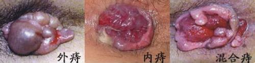 痔疮都有什么症状