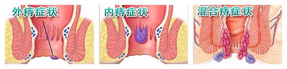 痔疮的症状