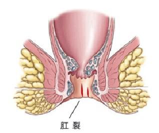 肛裂便血的原因