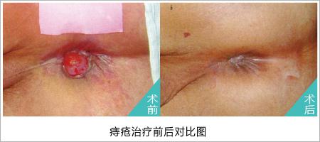 痔疮手术之后多长时间能痊愈