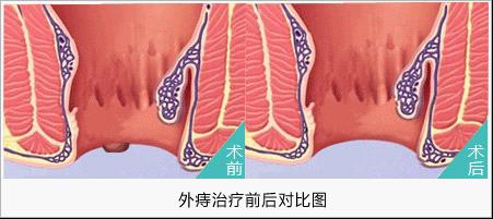 外痔不治疗的危害是什么