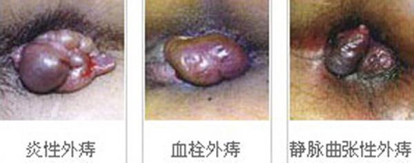 外痔怎么治疗好得快