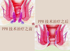 PPH治疗痔疮怎么样