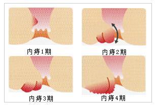 内痔是不是都需要做手术