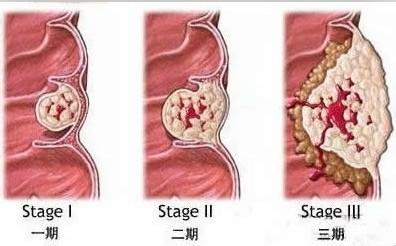 痔疮是怎么引起的