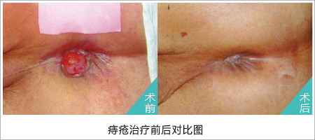 怎么判断自己是不是得了痔疮