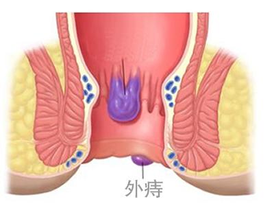 痔疮是怎么回事