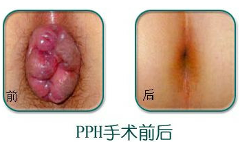 得了混合痔应该怎么治疗