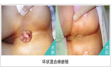 混合痔怎么治疗效果最好