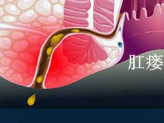 济南哪里治疗肛瘘不开刀