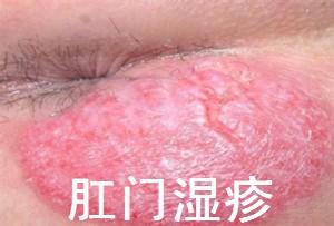 肛门湿疹有哪些危害