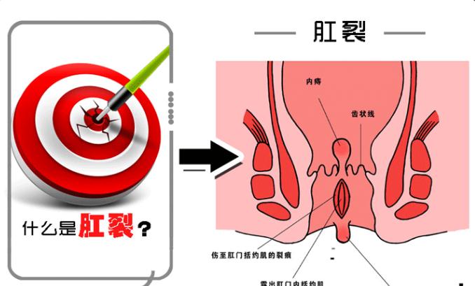 在济南治疗肛裂需要多少钱