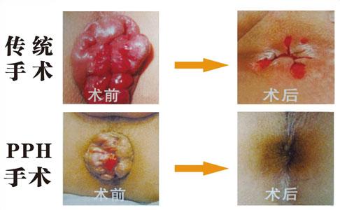 外痔用什么治疗效果最好