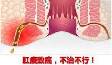 如何预防肛瘘